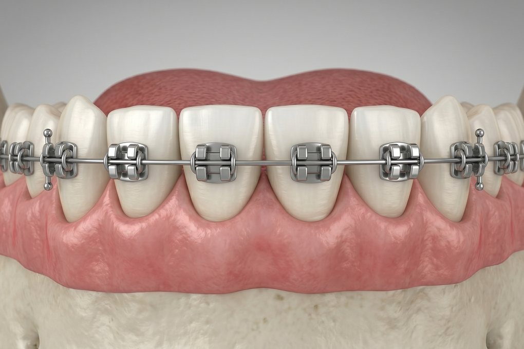 Braces (Metal, Ceramic & Lingual) illustration
