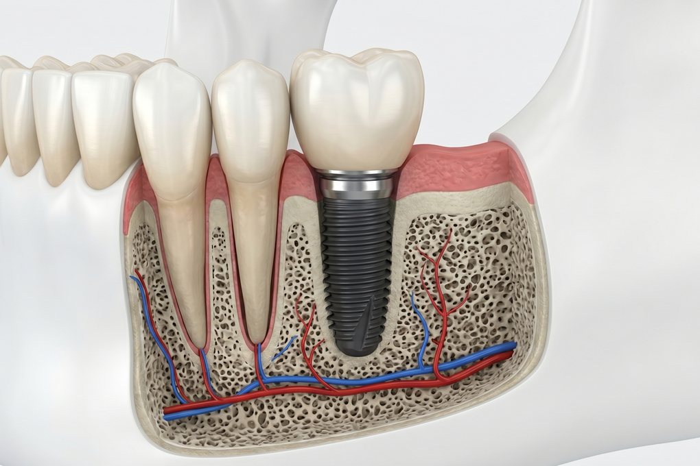 Dental Implants (Single Tooth) illustration