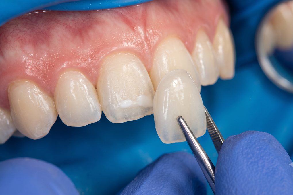 Dental Veneers (Composite & Porcelain) illustration